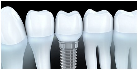 Dental Implant