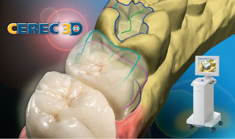 CEREC crown technology