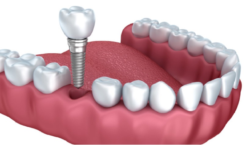 dental implants model showing how the procedure works