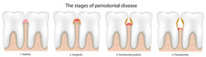 Artistic rendering of the 4 stages of periodontal disease