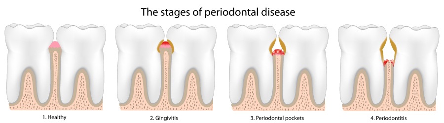 Artistic rendering of the 4 stages of periodontal disease