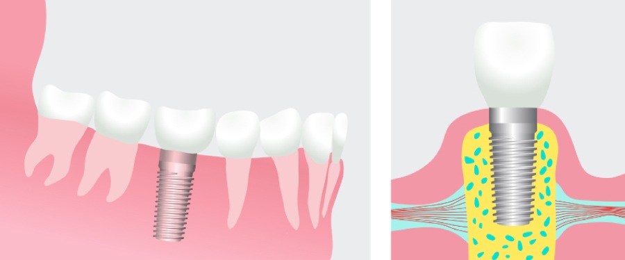 Graphic of a dental implant with a restoration