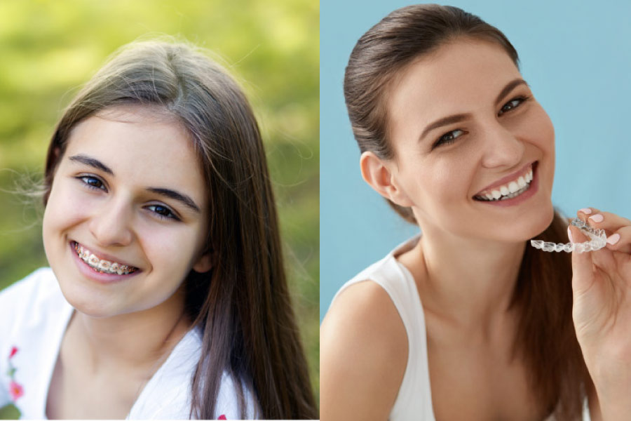 Brunette girl on the left wearing braces and brunette girl on the right holding a clear aligner
