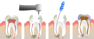 Graphic showing the steps of root canal therapy.