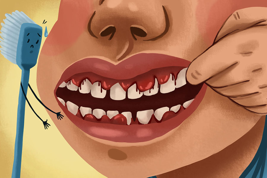 Cartoon of a mouth with gum disease indicated by bleeding gums.