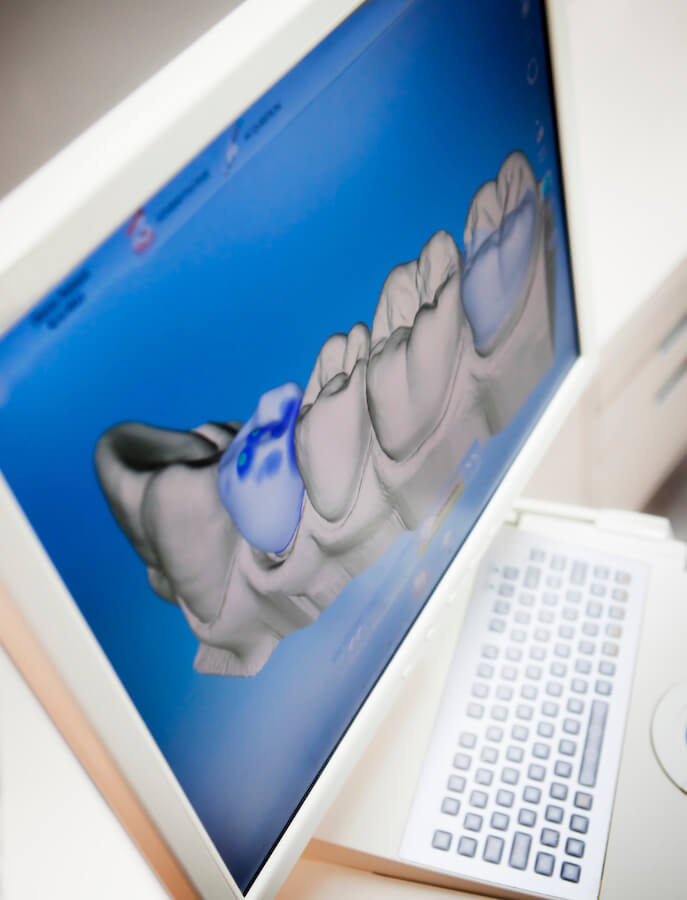 Digital impression of partial dental arch with treatment needed marked in blue, example of digital dentistry. 