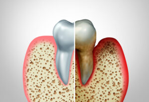 gum disease, untreated gum disease, gingivitis, gum health, periodontal disease, periodontitis