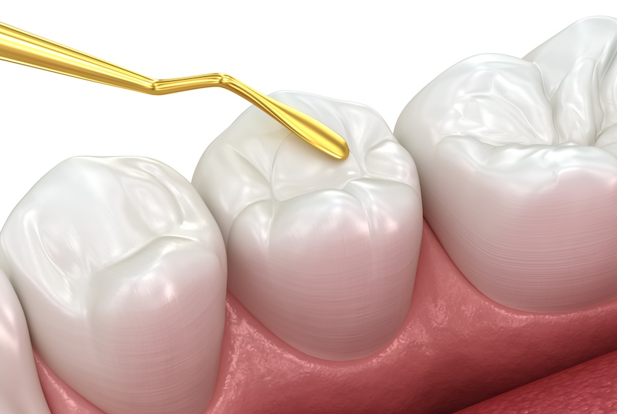 dental fillings, ceramic, amalgam, composite